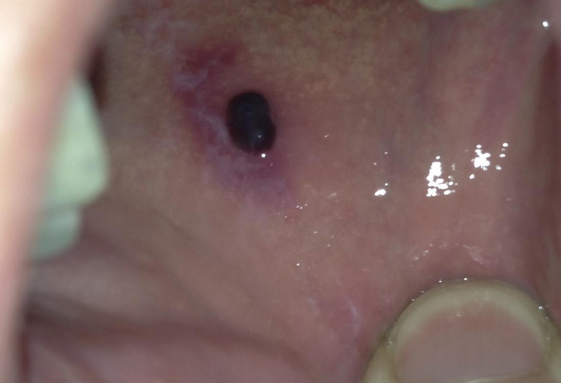 Blood Blister In Mouth Pictures And Treatment Dental Implants Chula 