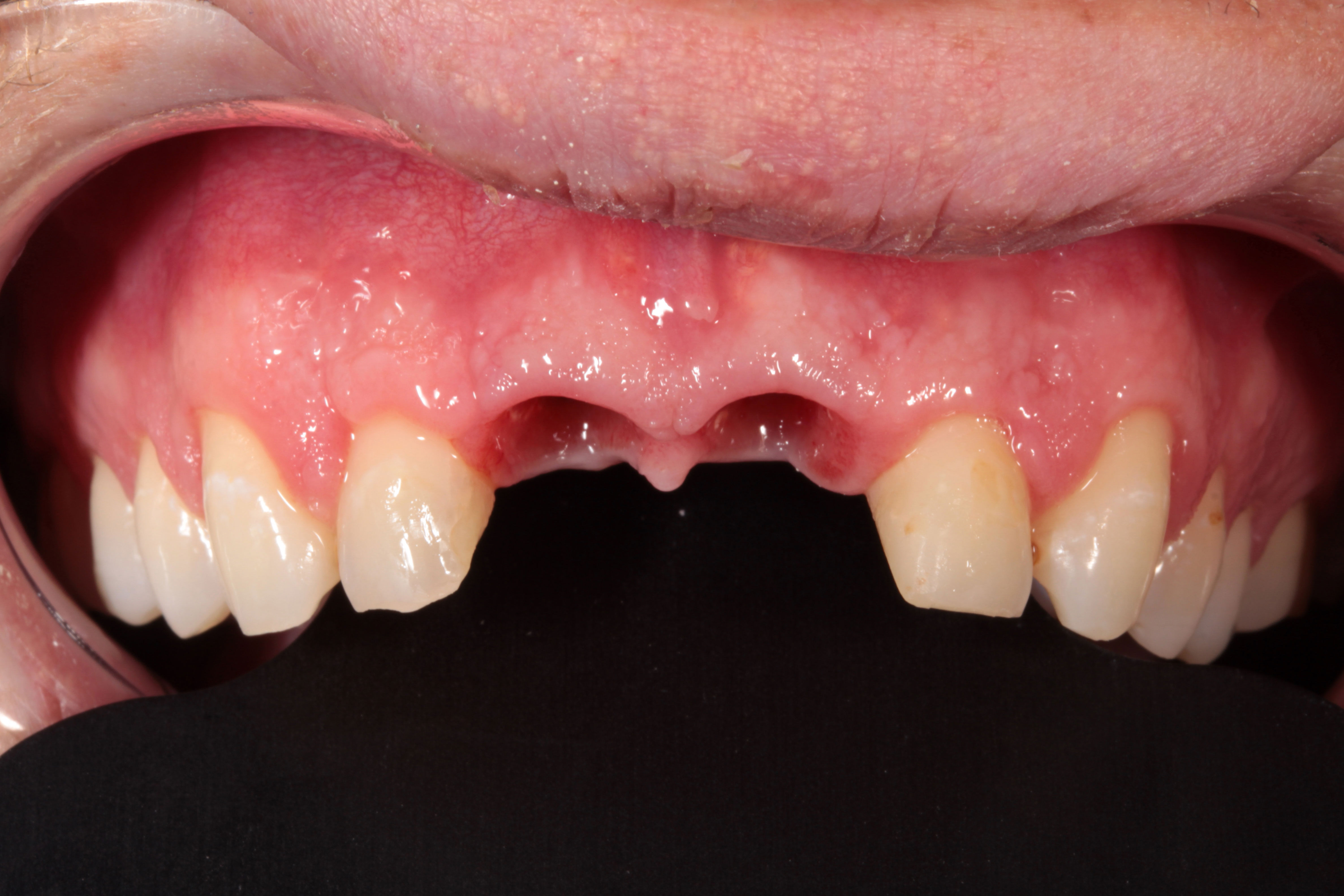 Implant Restoration Of Central Incisors Dental Implants Chula Vista