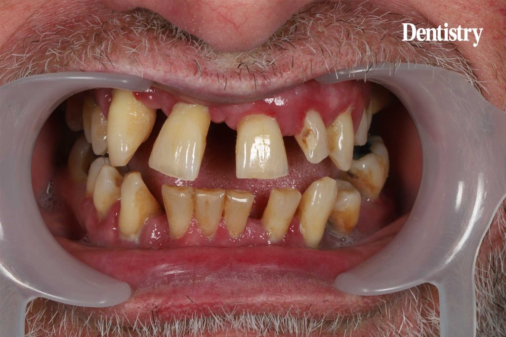 Highlighting patient care in a complex implant case