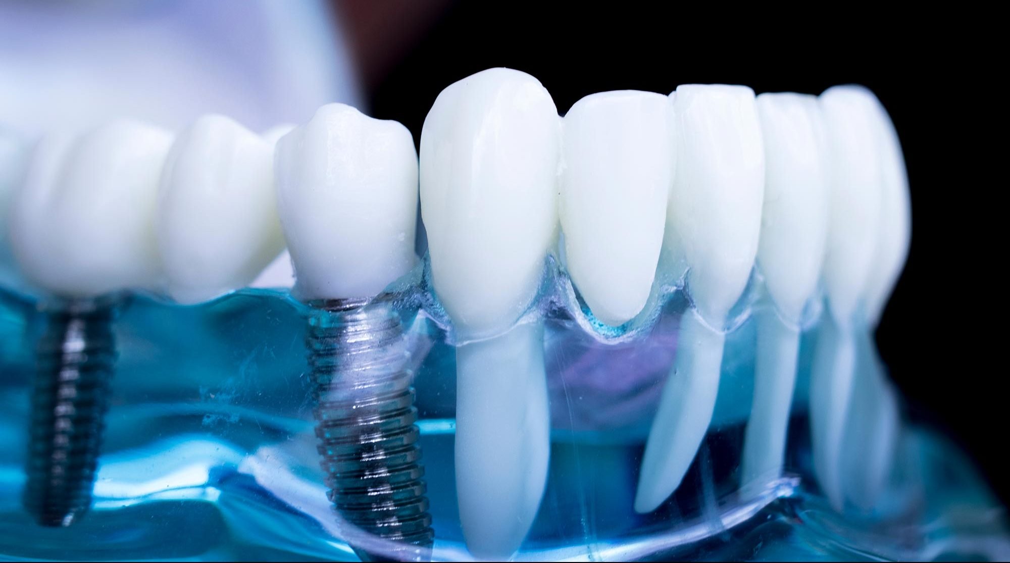 Dental implant showing dental implant training is coming to Portsmouth