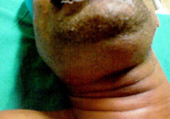 a close up of man neck with Ludwigs angina. Image credit: Anand H Kulkarni, Swarupa D Pai, Basant Bhattarai, Sumesh T Rao and M Ambareesha, 2008 