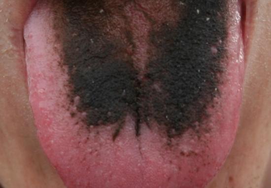 Black hairy tongue. Image credit: Com4, (2007, February 22)