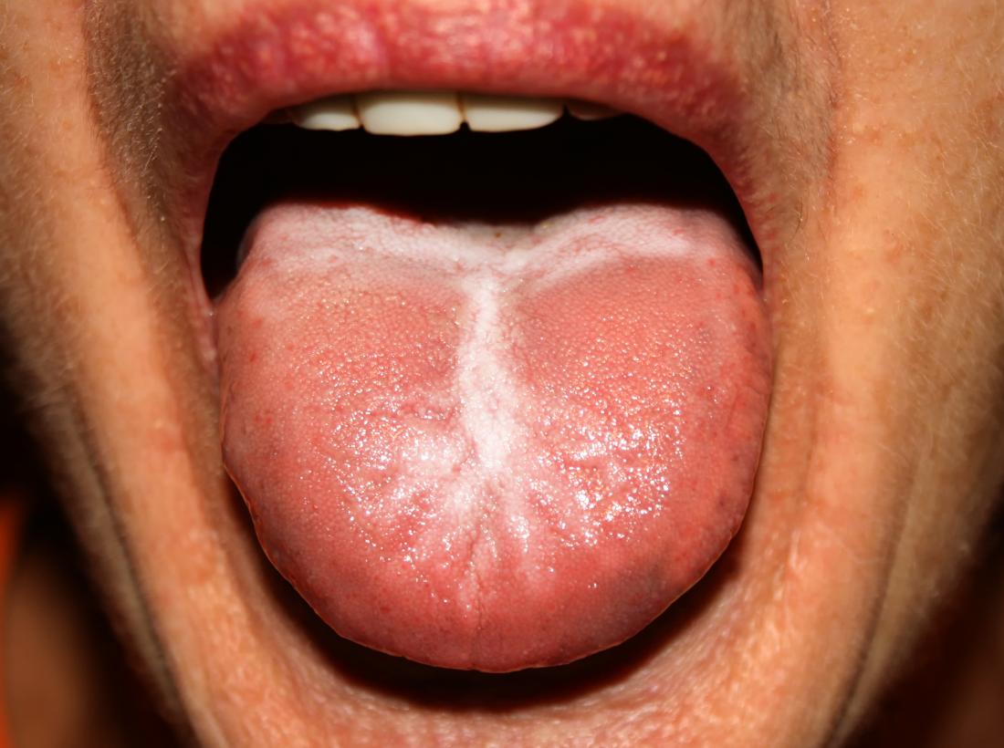 Candidiasis on the tongue