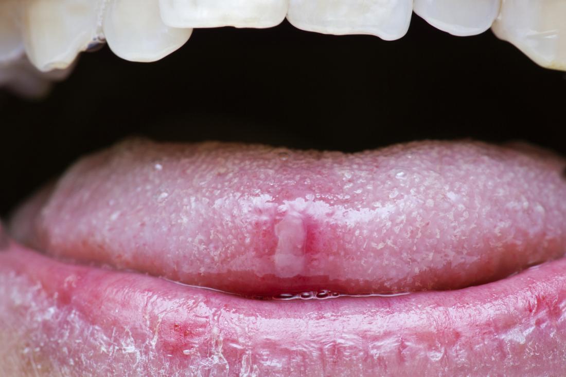 Canker sore on the tip of a persons tongue.
