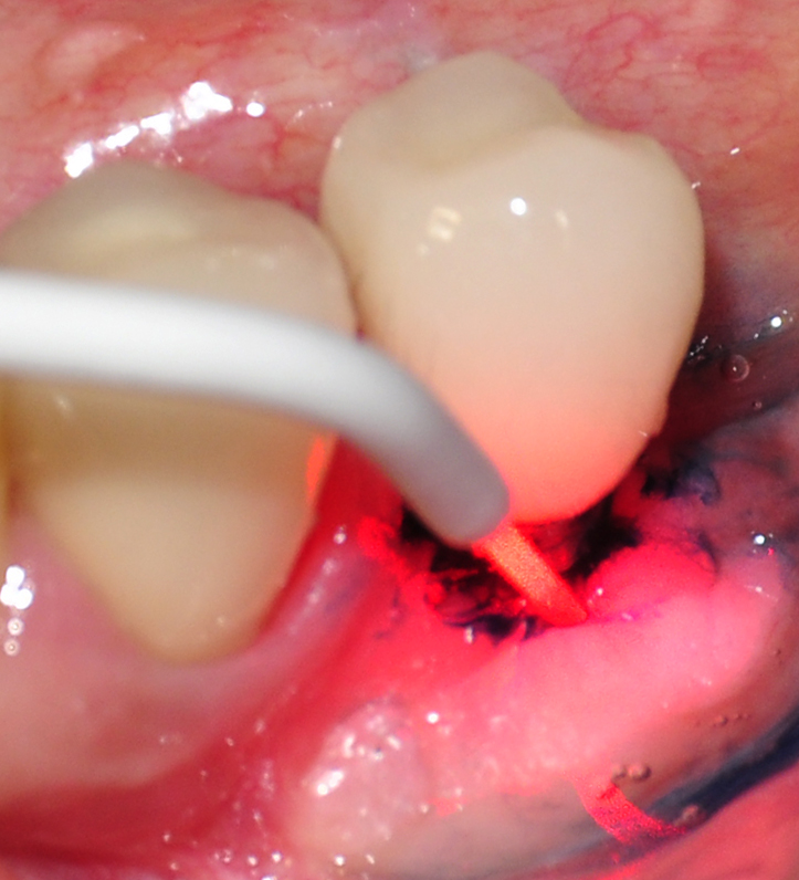 use of photodynamic therapy