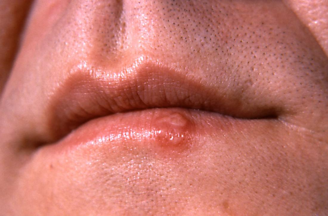 Herpes on lips. Image credit: CDC/ Dr. Hermann, 1964