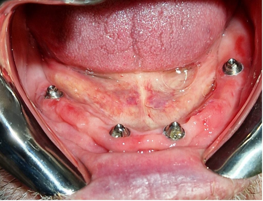 The 'all-on-four' concept restoration on lower jaw