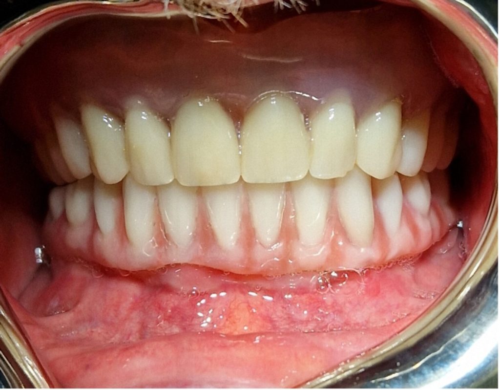 The 'all-on-four' concept restoration on lower jaw