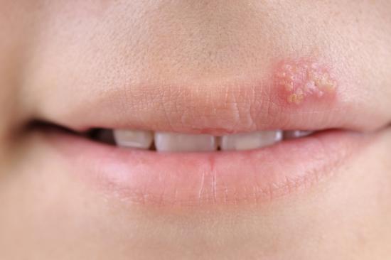 Oral herpes on top lip