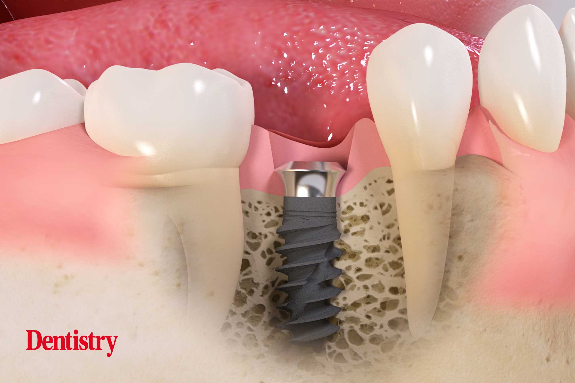 Tissue level implants – what are the benefits?