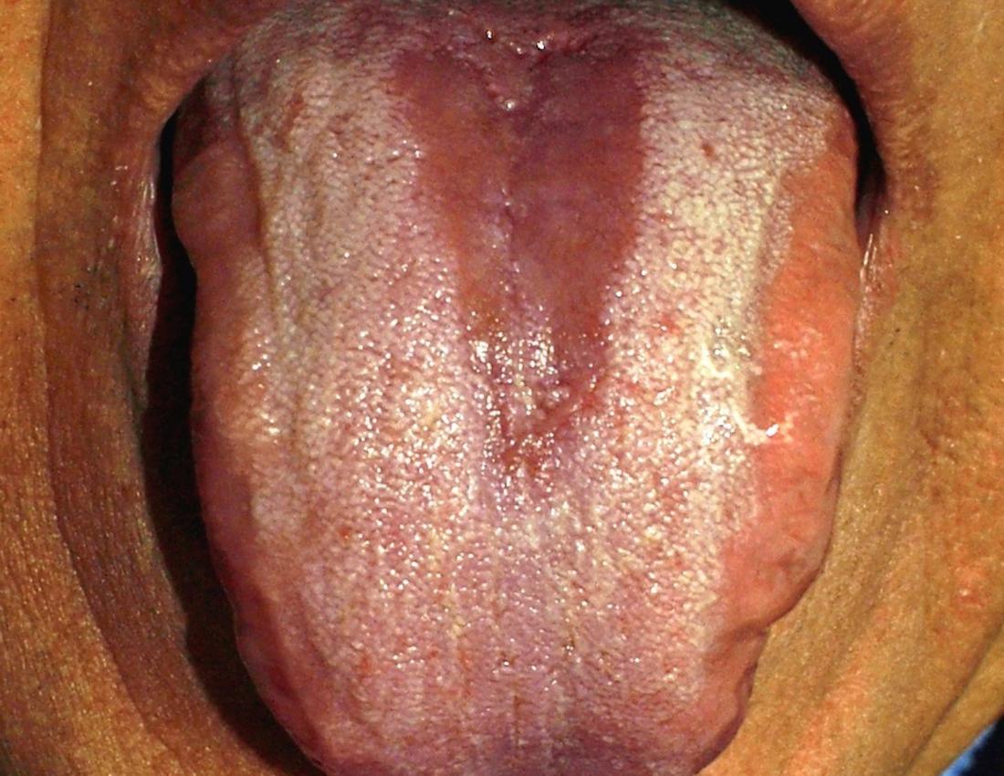 tongue with glossitis