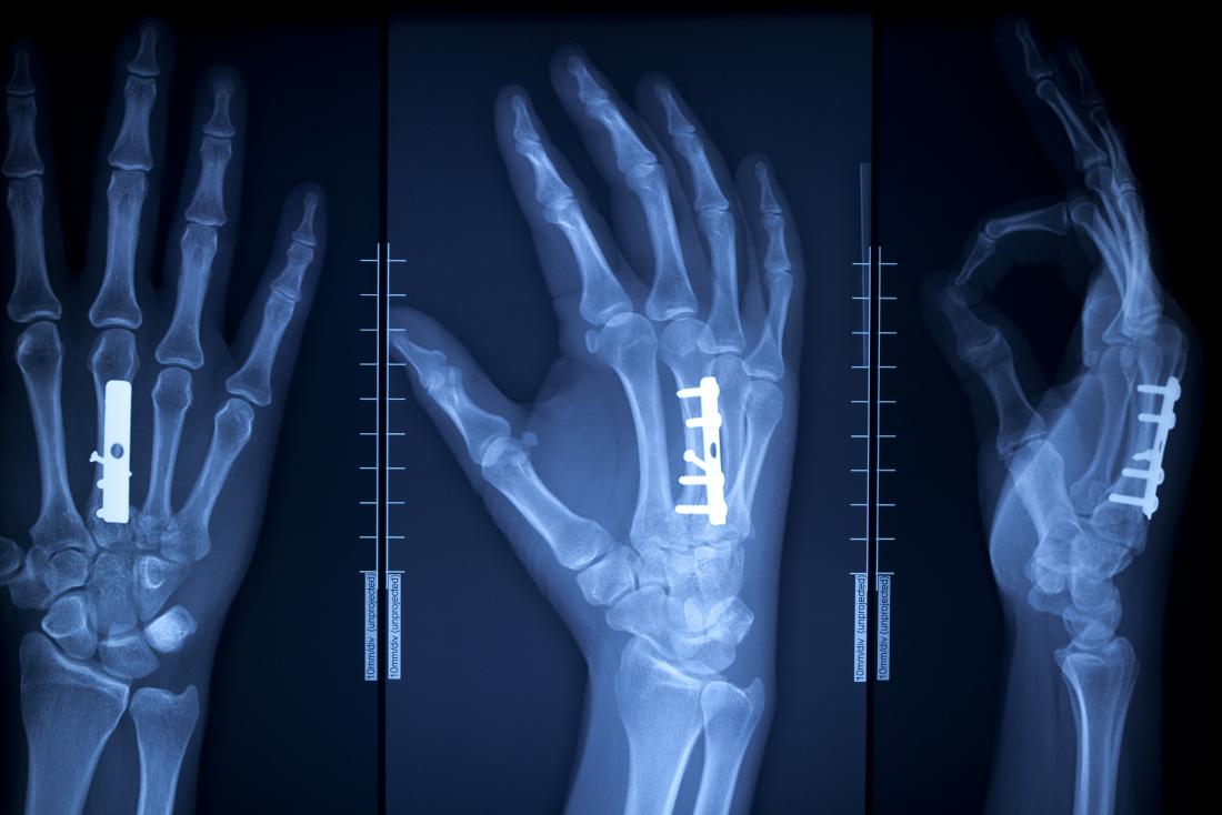 X-ray of hand with surgical pins and screws in the bone.